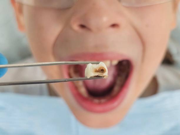 Best Emergency Dentist for Knocked-Out Tooth in Trinity, AL